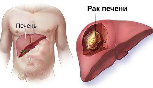 (Русский) Рак печени – это достаточно тяжелое в особенностях собственного течения заболевание, характеризуемое развитием в печени злокачественной опухоли.