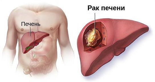 Рак печени – это достаточно тяжелое в особенностях собственного течения заболевание, характеризуемое развитием в печени злокачественной опухоли.